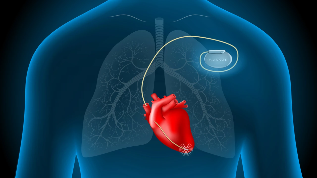 Pacemaker & Device Therapy